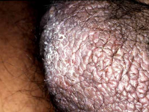lichen simplex scrotum 01