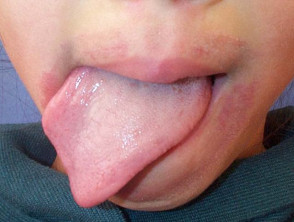 Lip licker's dermatitis