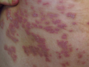 Psoriasis induced by lithium