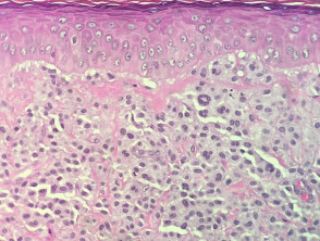 Maculopapular cutaneous mastocytosis