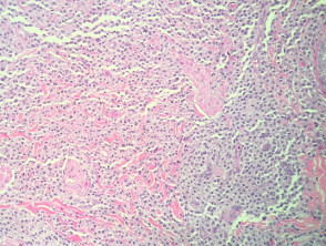 Maculopapular cutaneous mastocytosis