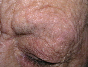 Madarosis due to atopic eczema
