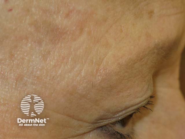 Madarosis due to lichen planopilaris