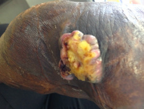 Marjolin ulcer in thermal burn scar
