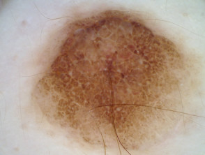 Melanocytic naevus, polarised dermoscopy view