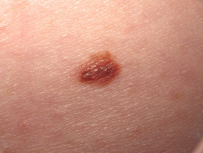 Small melanoma