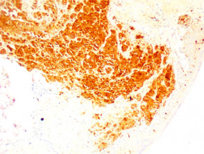 Folliculotropic melanoma pathology stained with S100 x100