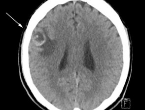 CT scan of brain with melanoma metastasis
