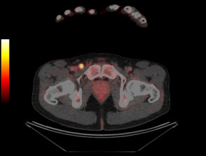 PET-CT scan revealing metastatic melanoma in groin