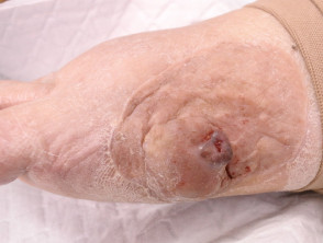 Metastatic melanoma arising within scar from excision of primary melanoma