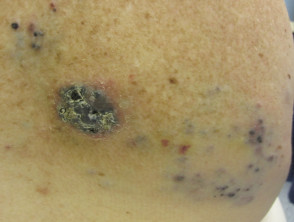Metastatic melanoma 