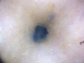 Metastatic melanoma dermoscopy