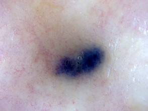 Metastatic melanoma dermoscopy