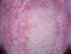 Morphoeic basal cell carcinoma dermoscopy