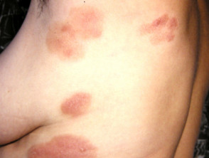 Patch stage mycosis fungoides