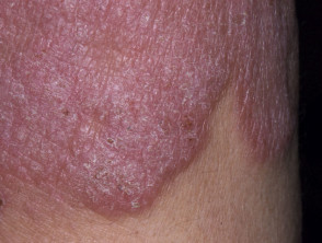 Plaque stage mycosis fungoides
