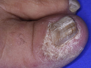 Mycosis fungoides affecting the great toenail