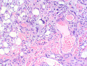 Myxoid liposarcoma pathology