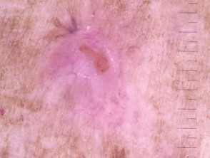 Nodular basal cell carcinoma, nonpolarised dermoscopy view