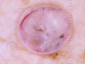 Polarised dermoscopy of a nodular basal cell carcinoma presenting as an exophytic polyp