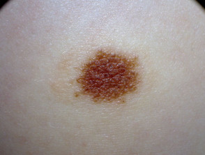 Melanocytic naevus with a fading border