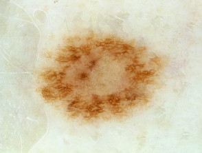 Naevus, skin type 1, dermoscopy 2