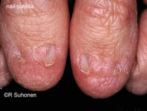 Nail patella syndrome
