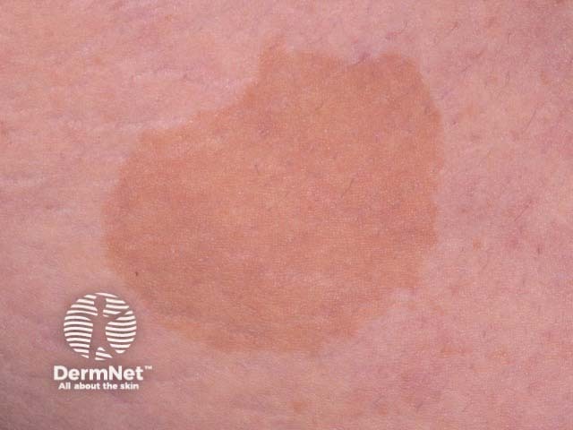 Café au lait macule