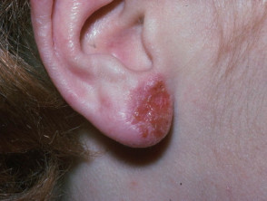 Contact allergic dermatitis in child