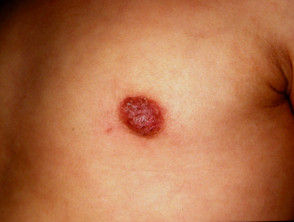 Nipple eczema