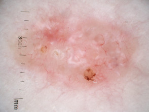 Nonpigmented nodular basal cell carcinoma dermoscopy