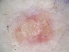 Nodular basal cell carcinoma, polarised dermoscopy view