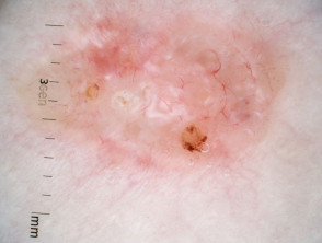 Nodular basal cell carcinoma, polarised dermoscopy view