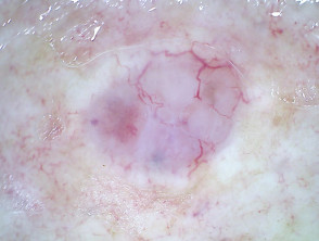 Nodular basal cell carcinoma, nonpolarised dermoscopy view