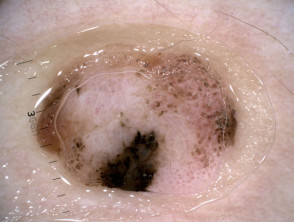 Nodular melanoma, Breslow 2.5 mm, nonpolarised dermoscopy view