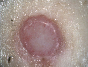 Nodular melanoma, Breslow 3.4 mm, nonpolarised dermoscopy view