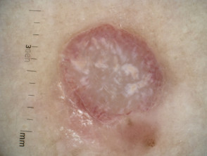Nodular melanoma, Breslow 3.4 mm, polarised dermoscopy view