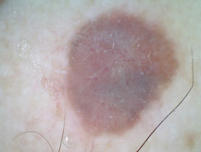 Nodular amelanotic melanoma nonpolarised dermoscopy view