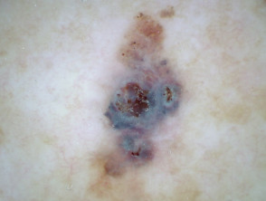 Unpolarised dermoscopy of melanoma
