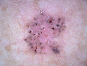 Nonpolarised dermoscopy of pigmented basal cell carcinoma