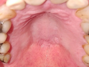 Oral squamous cell papilloma