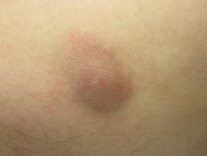 Panniculitis due to atypical mycobacterial infection