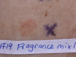 Positive patch test to fragrance mix I