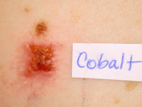 Positive patch test to cobalt