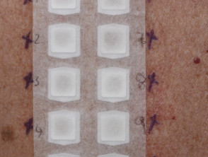 Patch tests applied to skin of upper back