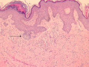 Pathology of dermatofibroma