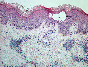 Pathology of acute eczema