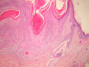 Pathology of invasive squamous cell carcinoma
