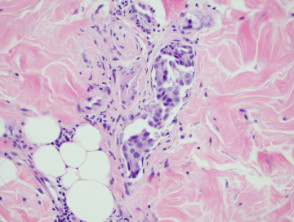 Carcinoma erysipeloides