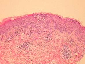Acute Generalised Exanthematous Pustulosis (AGEP) pathology 